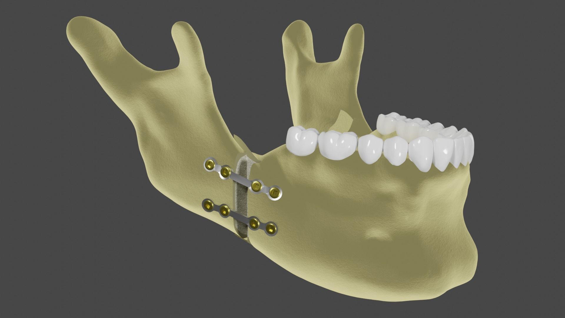 Orthognatic surgery Titanium plates in the mandible 3D model CGTrader