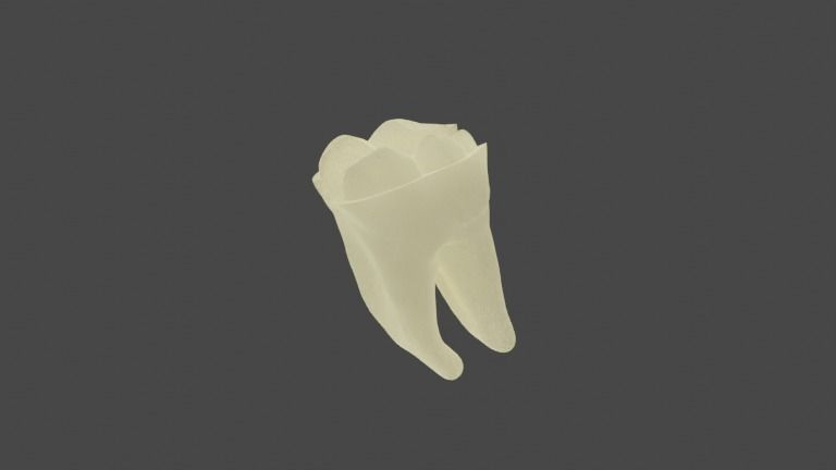 Dental restoration - Metallic Overlay 3D model | CGTrader