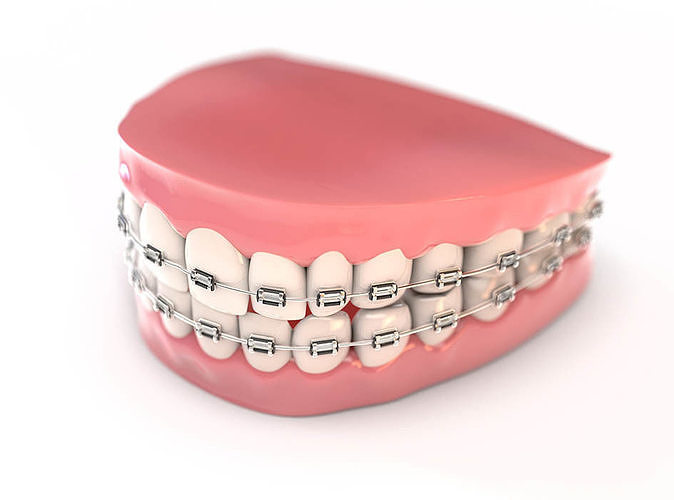 Fake Teeth And Braces 3D model | CGTrader