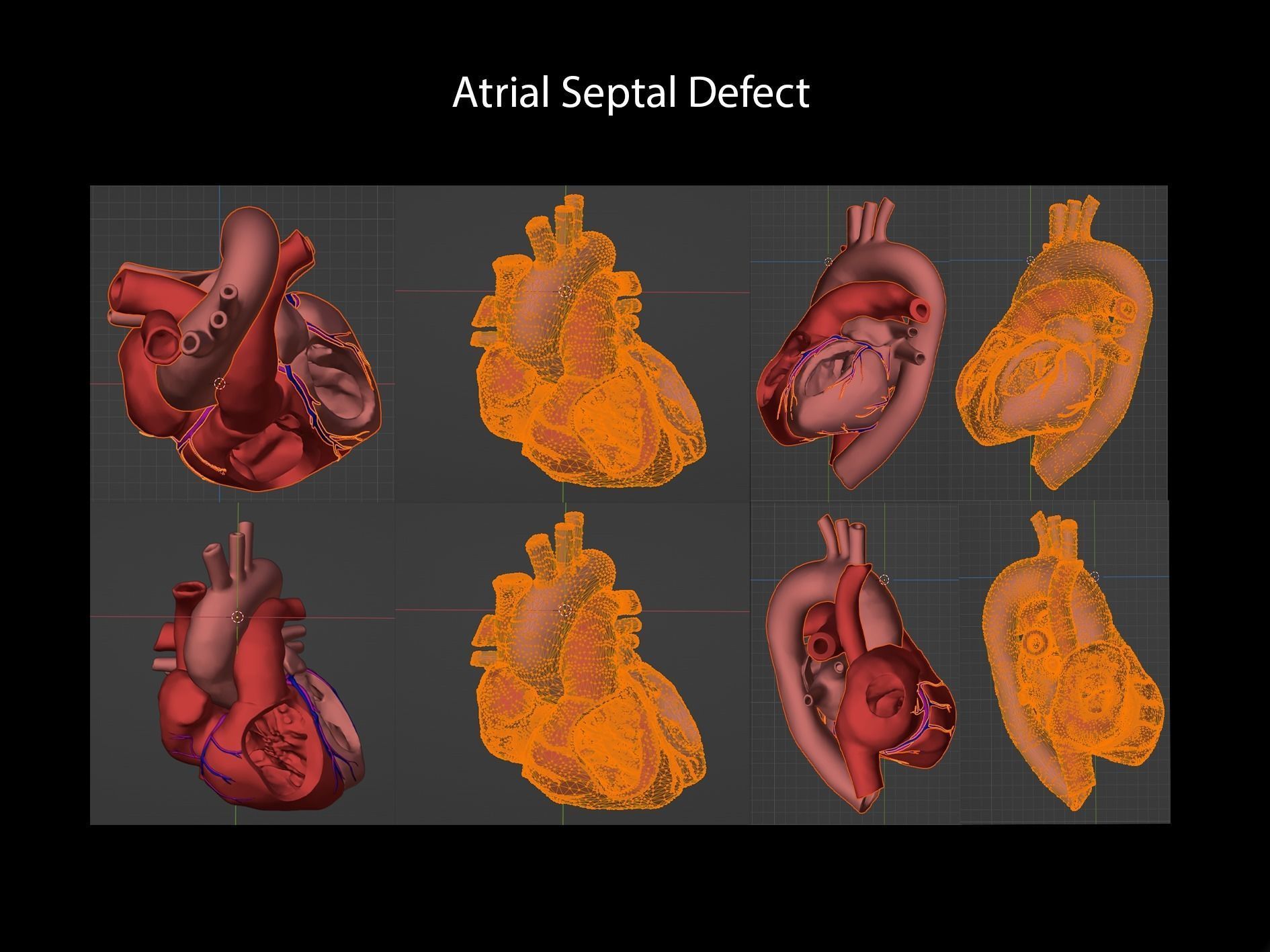 Congenital Heart Disease 7pack 3D model CGTrader
