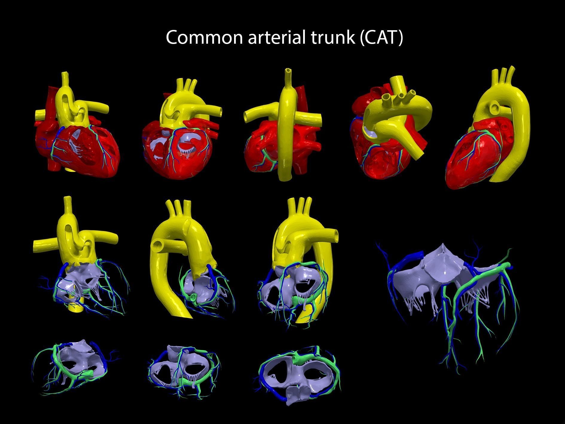 Congenital Heart Disease 7pack 3D model CGTrader